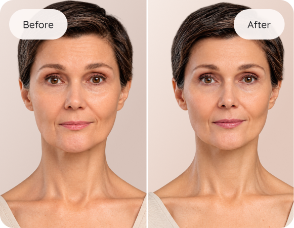 Before and after Bio-CARE results at Desert Med Rejuvenation in Rancho Mirage. Individual results may vary.