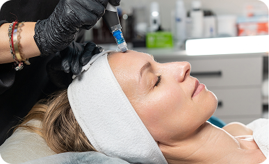 Microneedling with PRF treatment being performed at Desert Med Rejuvenation.