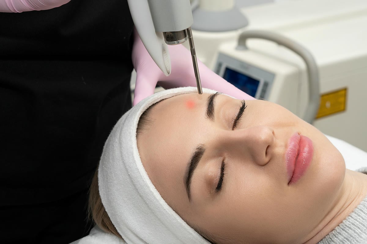 CO2 laser treatment on a patient’s face at the La Quinta sister office of Desert Med Rejuvenation.