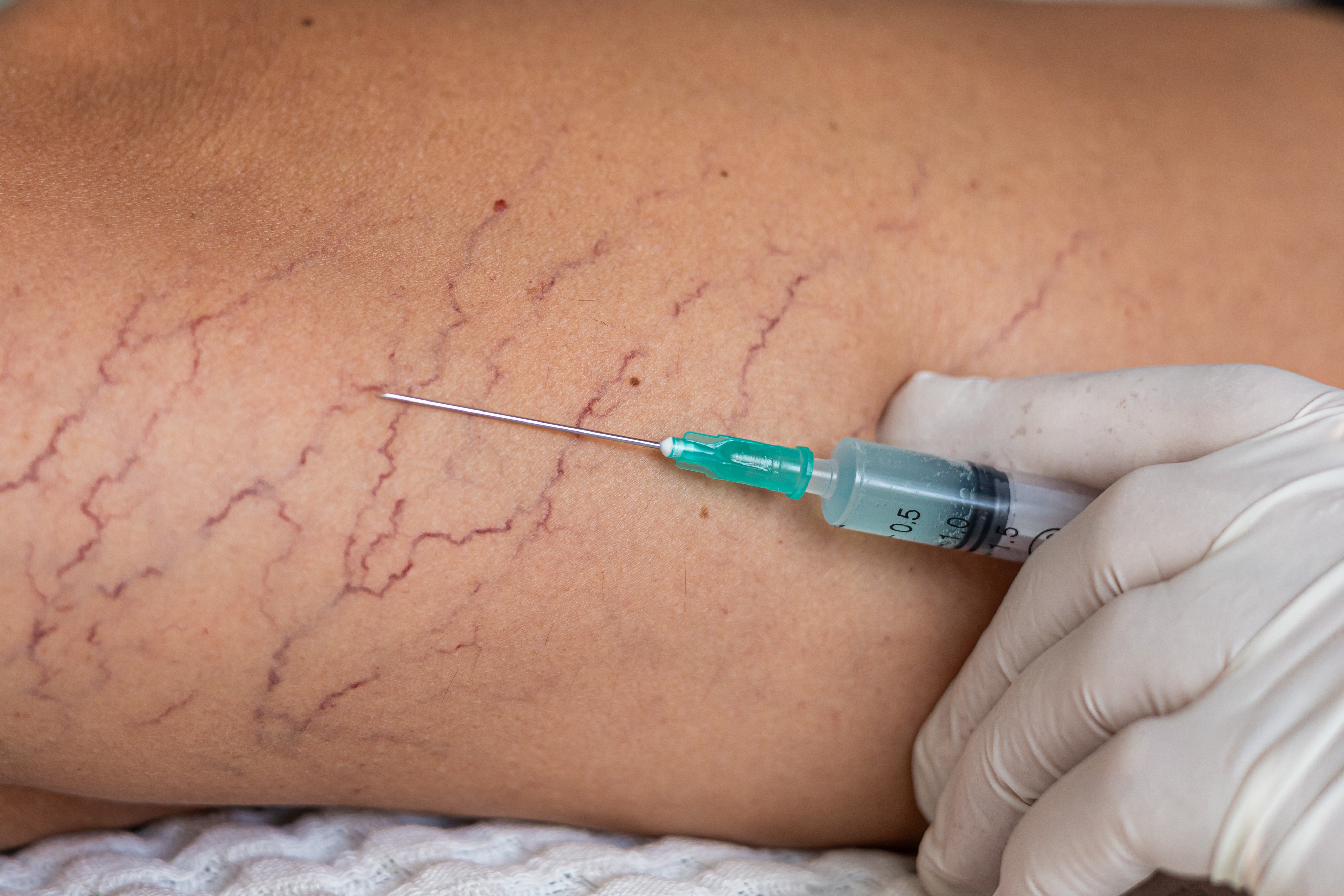 Sclerotherapy spider vein treatment at Desert Med Rejuvenation in Rancho Mirage.