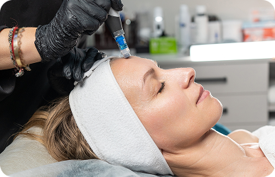 Microneedling with PRF treatment at Desert Med Rejuvenation.
