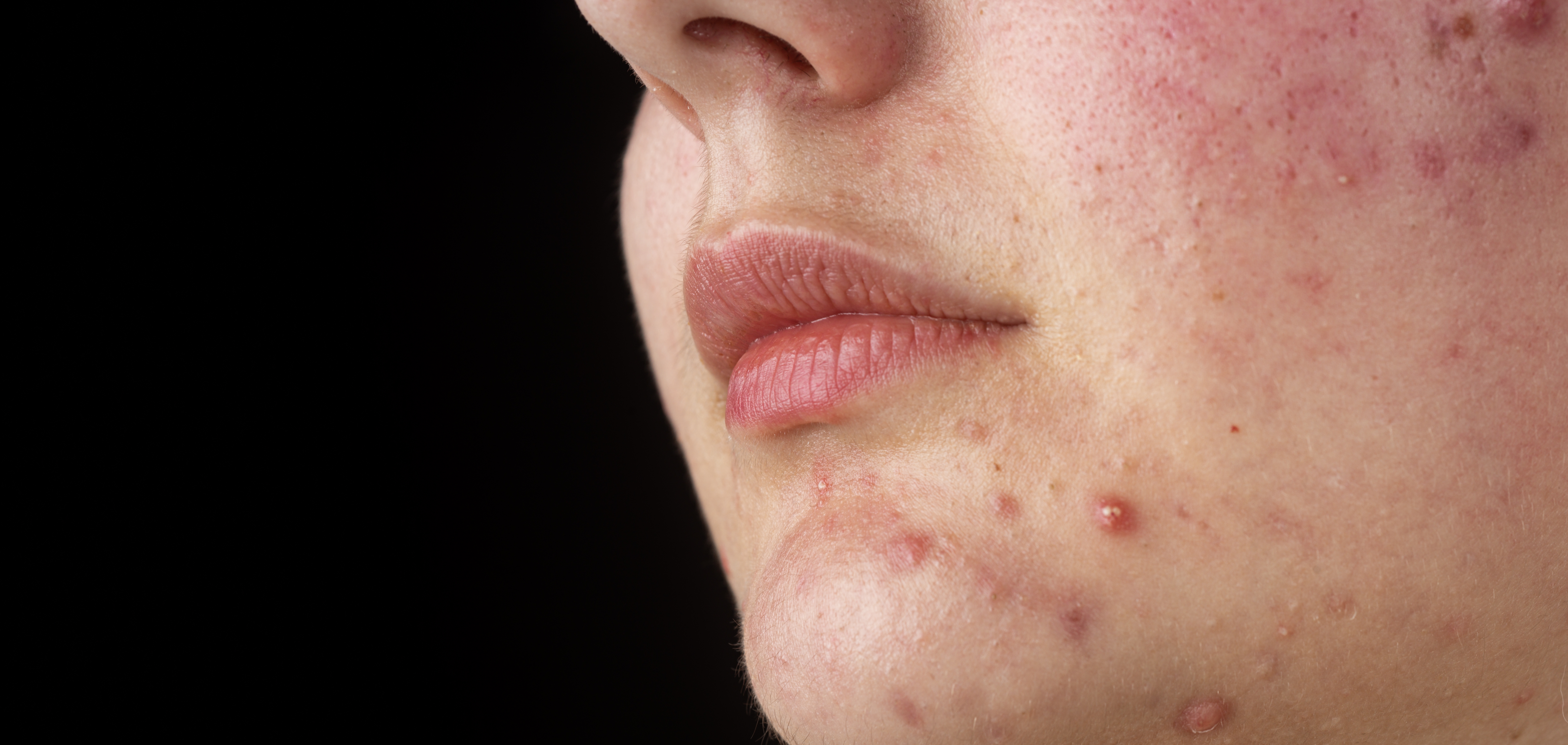 Acne and acne scar treatment at Desert Med Rejuvenation.