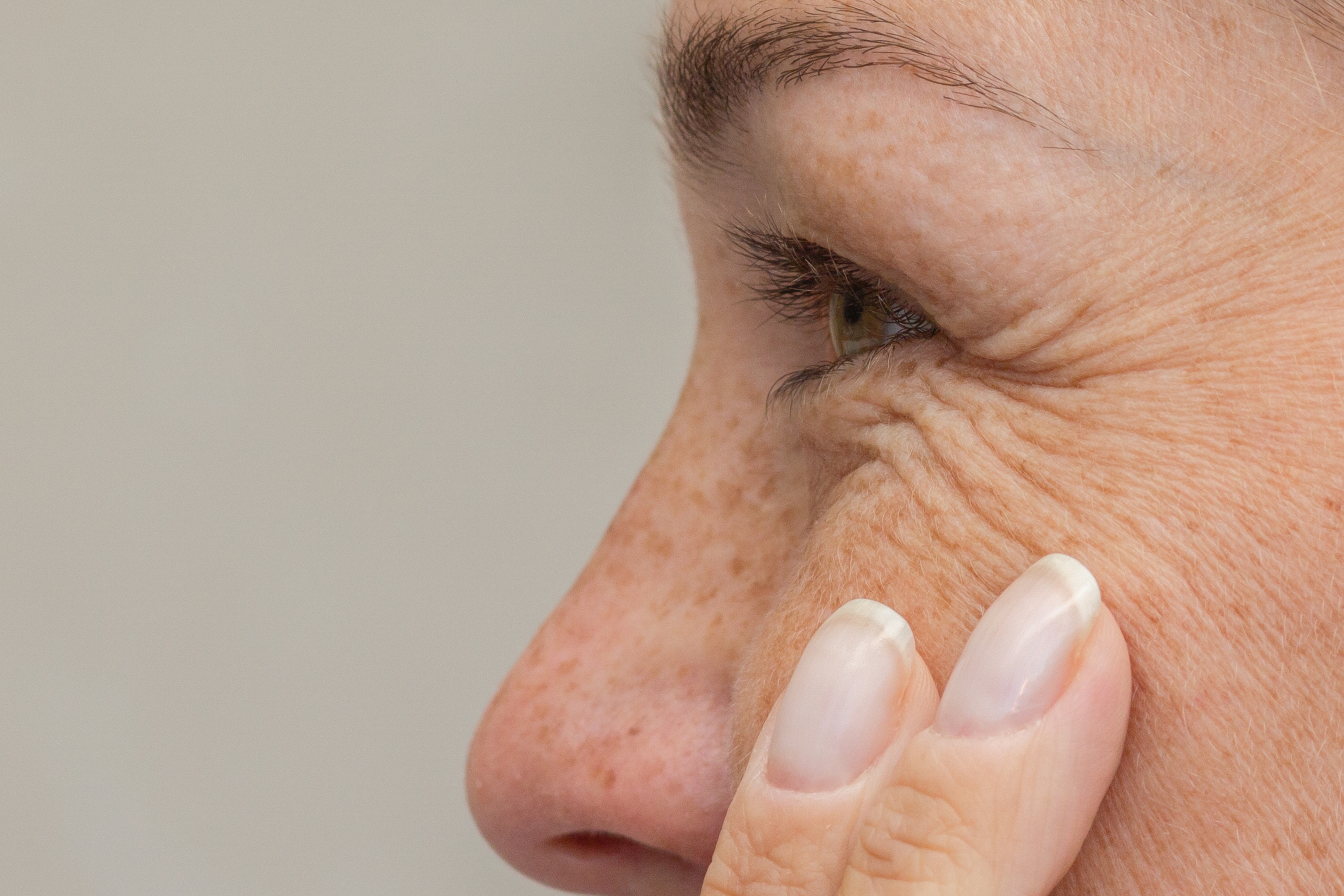 Fine lines and wrinkles around the eyes, treated at Desert Med Rejuvenation.